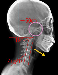 顎関節症が発症している首