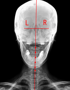 正常の頚椎（首骨）