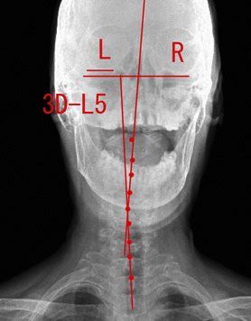 歪みのある頚椎（首骨）