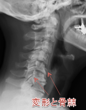 頸椎の変形と骨棘